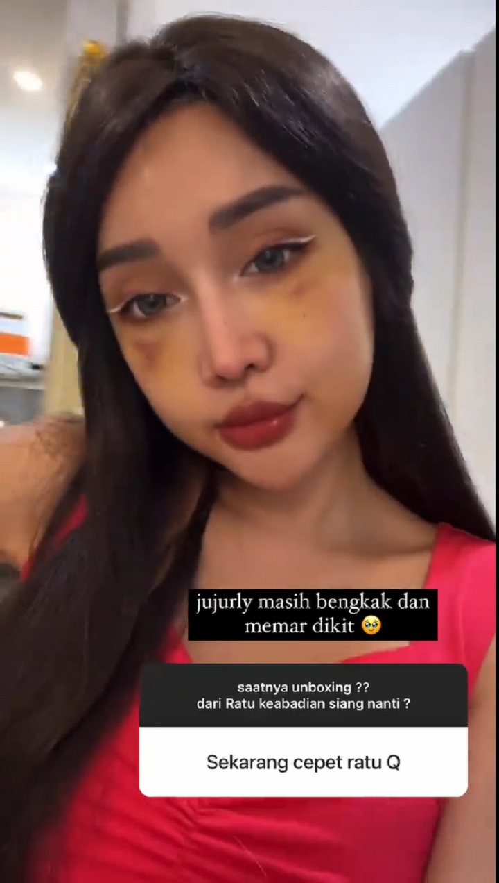 Masih bengkak dan memar