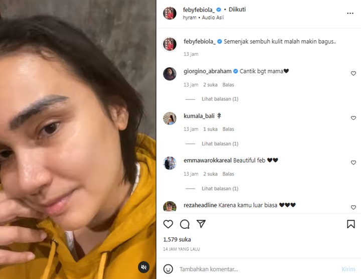 Bikin Takjub, Feby Febiola Perlihatkan Kondisi Kulit Wajahnya Makin Bagus Pasca Sembuh dari Kanker