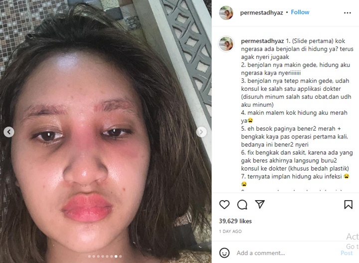 Anak Farida Nurhan Alami Infeksi Implan Bekas Oplas Hidung, Kondisi Wajahnya Mengkhawatirkan