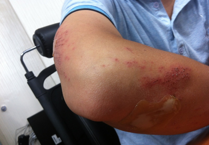 Bisa Sebabkan Penyakit Kulit