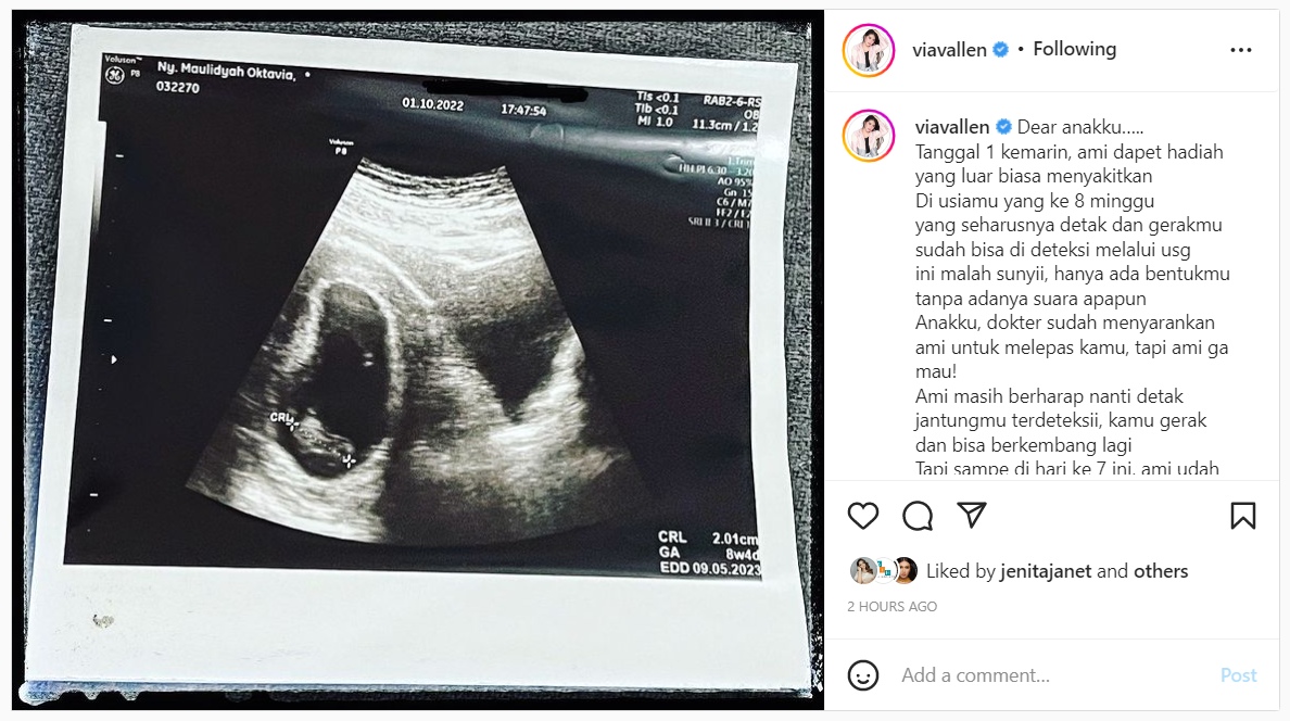 Nyesek! Via Vallen Sebut Jantung Janin yang Dikandungnya Tak Berdetak