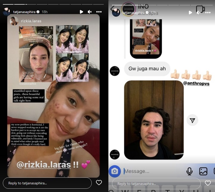 Tatjana Saphira Minta Tak Dibully Usai Tunjukkan Wajah Penuh Jerawat
