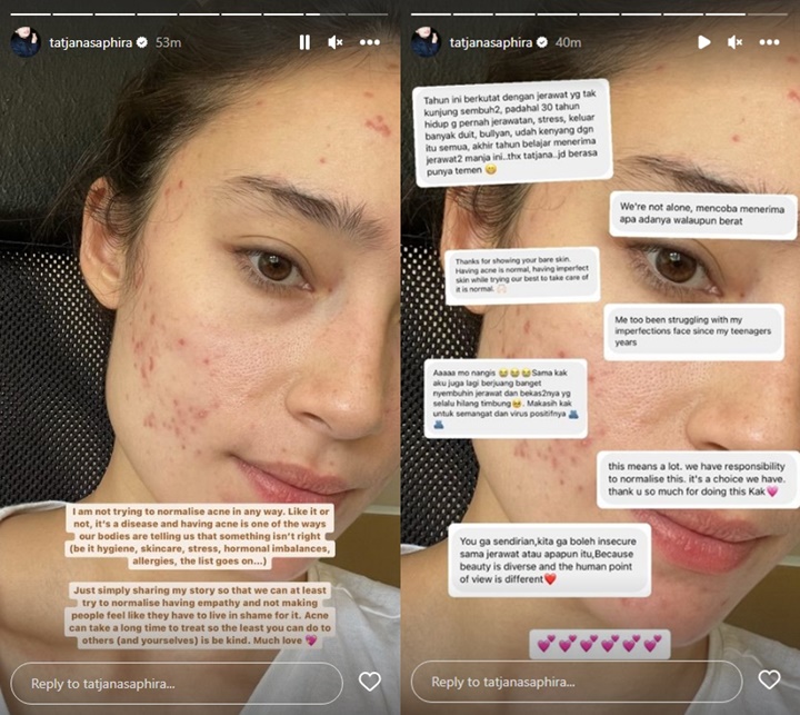 Tatjana Saphira Minta Tak Dibully Usai Tunjukkan Wajah Penuh Jerawat