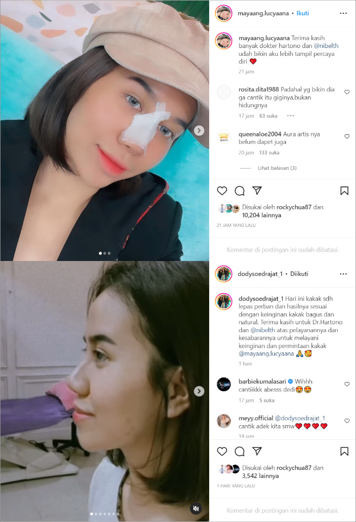 Adik Vanessa Angel Lepas Perban Operasi Hidung, Hasilnya Jadi Perbincangan