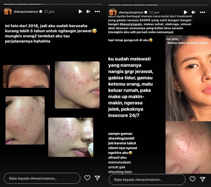 Bikin Angga Yunanda Bucin, Shenina Cinnamon Pamer Wajah Penuh Jerawat