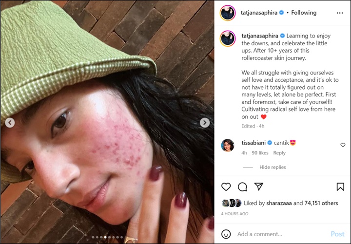Tatjana Saphira Bagikan Lebih Banyak Foto Wajah Penuh Jerawat, Dipuji Tetap Cantik