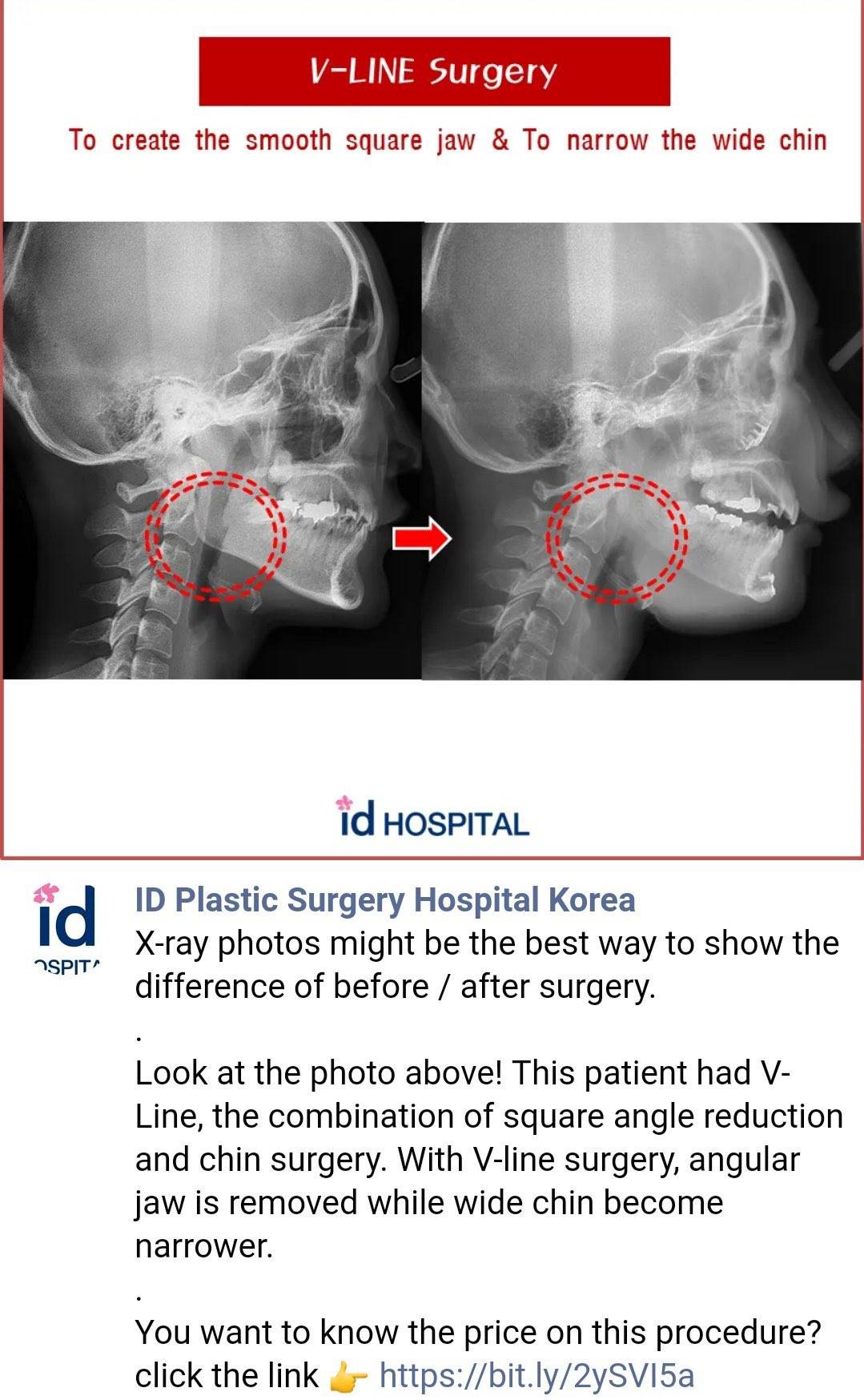 Penjelasan soal perbedaan X-Ray oplas dan tidak