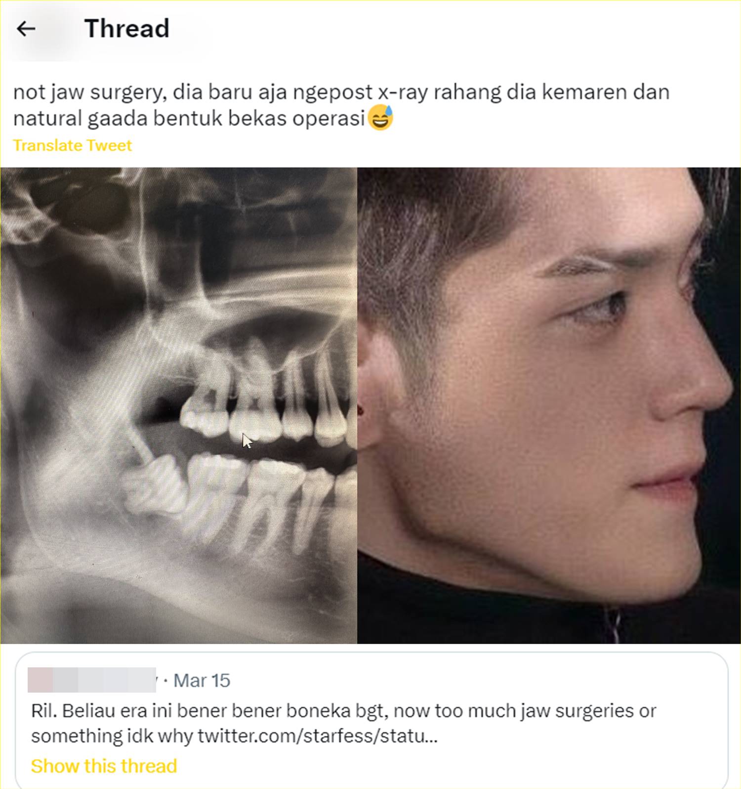 Perbandingan X-Ray dan rahang Taeyong NCT