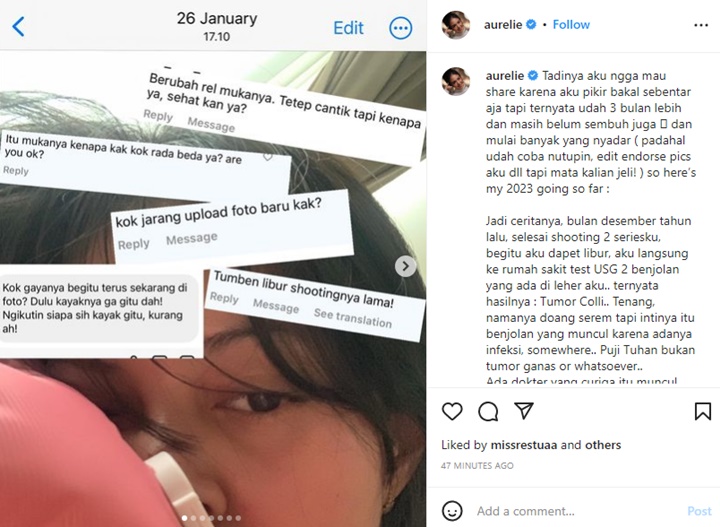 Aurelie Moeremans Divonis Tumor Colli, Rahang Alami Kelumpuhan Usai Disuntik