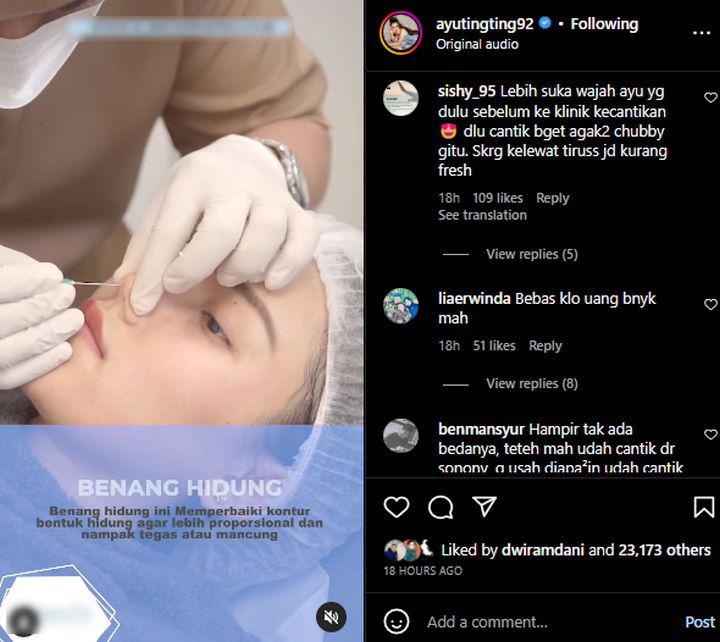 Ayu Ting Ting Tanam Benang Hidung