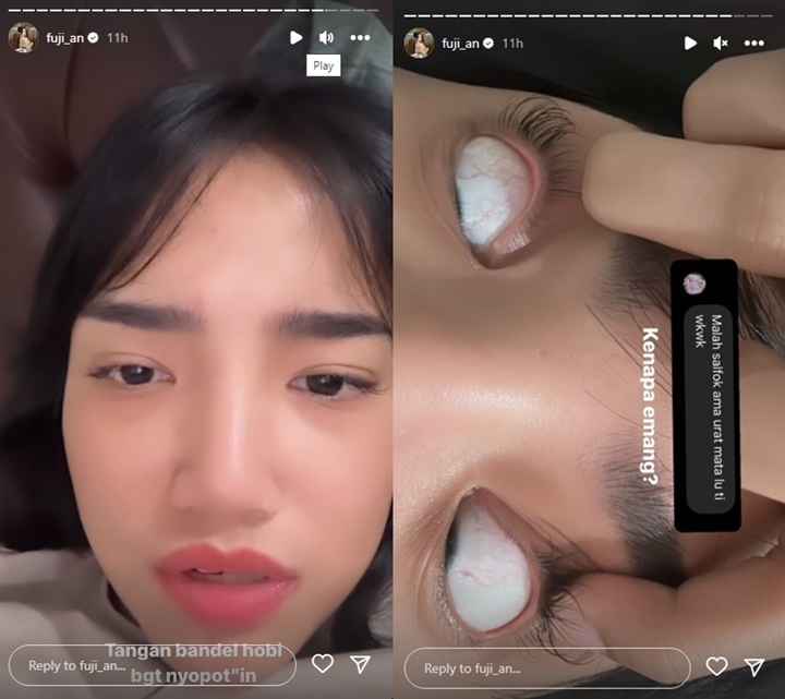 Fuji An Tunjukkan Kondisi Bulu Matanya yang Botak Gara-gara Ulah Sendiri