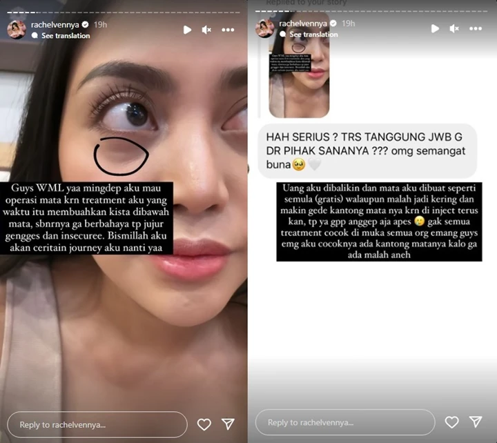 Rachel Vennya Idap Kista di Bawah Mata Efek Perawatan yang Gagal