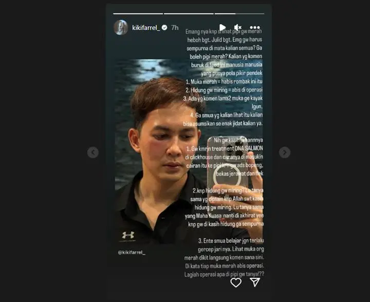 Kiki Farrel Emosi Dituduh Permak Wajah Imbas Foto dengan Pipi Memerah