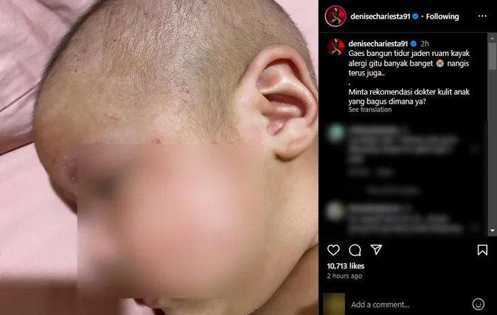 Denise Chariesta Galau Wajah Anak Penuh Luka Ruam