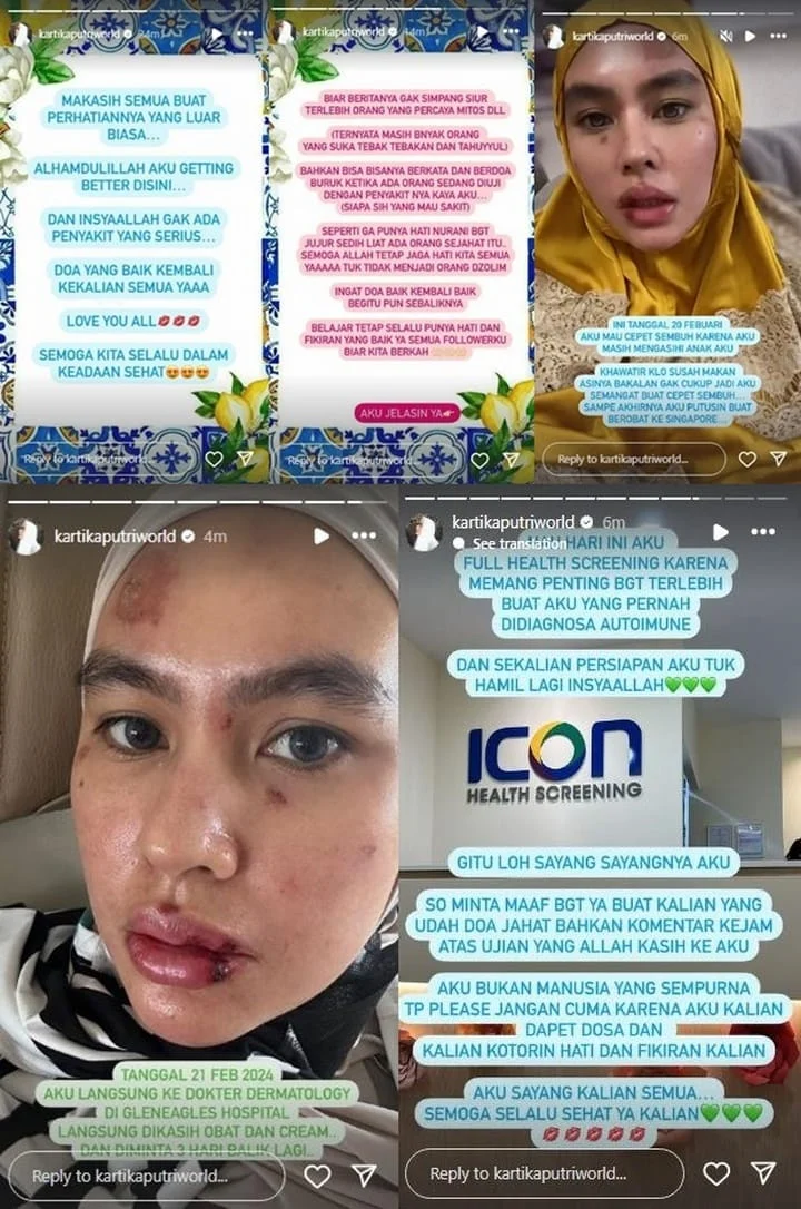 Kartika Putri Jelaskan Kronologi Penyakit Wajahnya