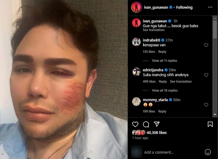 Ivan Gunawan Berwajah Memar Bikin Rekan Artis Khawatir