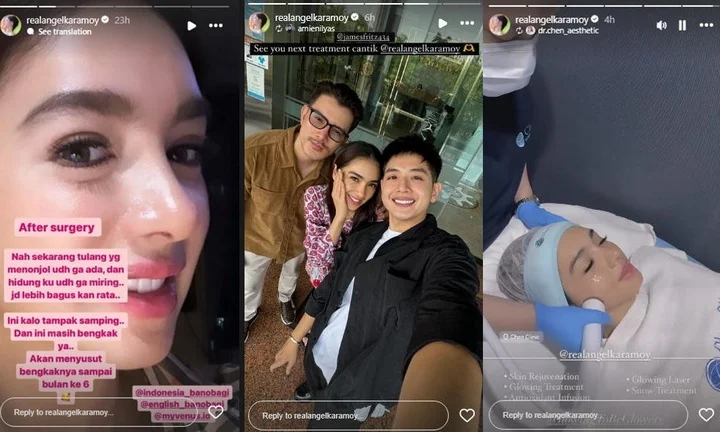 Angel Karamoy pasca Oplas