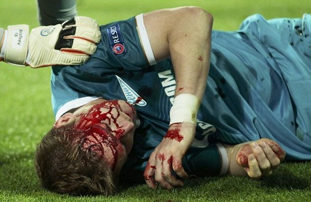 Gambar Foto Tomas Hubocan Mandi Darah di Laga Dortmund vs Zenit