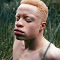 Albino Tidak Hanya Dialami Orang Berkulit Putih. Bangsa Afrika Juga Bisa, Seperti yang Terlihat pada