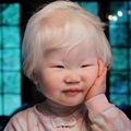 Kasus Albino Terjadi Karena Kulit Tidak Bisa Memproduksi Melanin. Melanin yang Memberi Warna Pada Ku