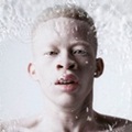 Terdapat Berbagai Macam Albino, Namun yang Paling Umum adalah Albino Oculocutaneous. Albino Ini Memp