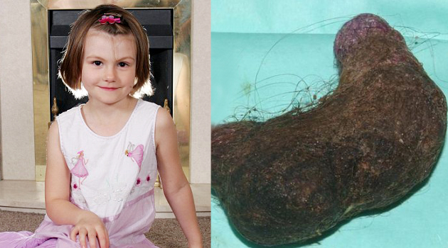 Hasil gambar untuk sindrom rapunzel