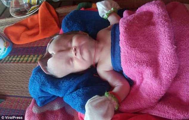 Bayi Ini Kehilangan Separuh Tengkorak, Orangtua Sedih Tak Bisa Biayai Operasi Hingga Minta Sumbangan
