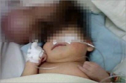 Bayi Dengan Otak di Luar Kepala Lahir di Sumatera Utara