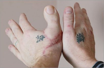 Seorang Pria Pasang Jempol Kaki Jadi Jempol Tangan