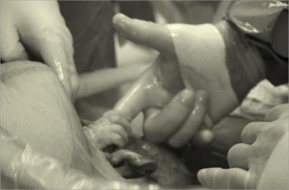 Wow, Bayi Genggam Jari Dokter dari Dalam Kandungan