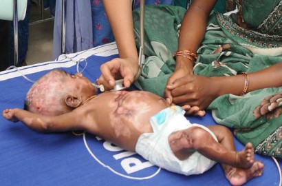 Aneh, Bayi di India Ini Sudah 4 Kali Mendadak Terbakar Sendiri