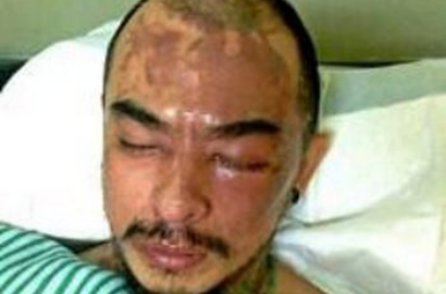 Artis dan Fans Doakan Kesembuhan Barry Saint Loco Usai Disiram Air Keras