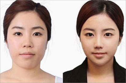 Terlalu Ekstrim, Klinik Oplas di Korsel Beri Sertifikat Keaslian Wajah