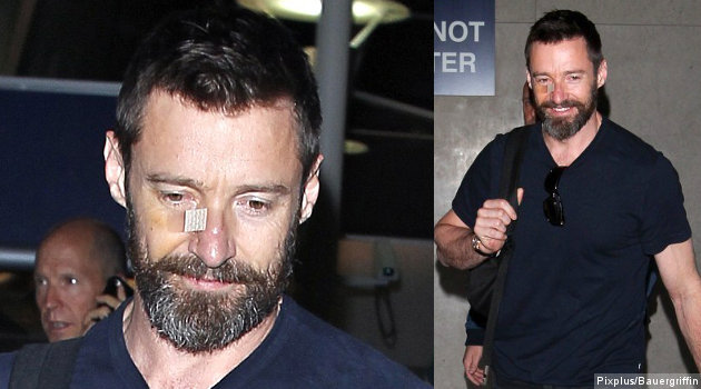 Hugh Jackman Ungkap Kondisinya Baik Pasca Operasi Kanker Kedua