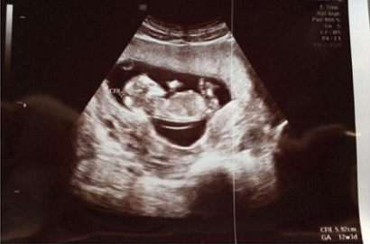 Gisella Anastasia Pamer Foto USG Calon Anak Pertama