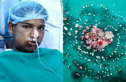 Dokter di India Cabut 232 Gigi dari Mulut Remaja 17 Tahun