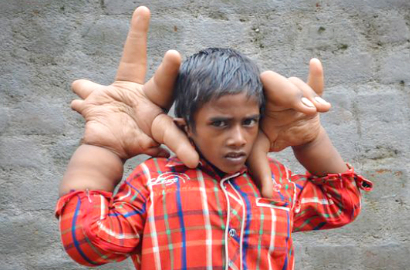 Bocah Berjari Raksasa di India Tak Boleh ke Sekolah