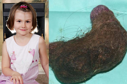 Hobi Makan Rambut, Gadis Ini Menderita Sindrom Rapunzel
