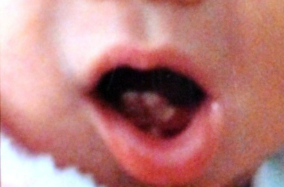 Bayi Terlahir Sudah Punya 2 Gigi Bikin Ibu Khawatir Menyusui