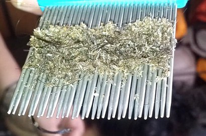 Ribuan Kutu di Rambut Gadis Ini Bikin Netter Bergidik
