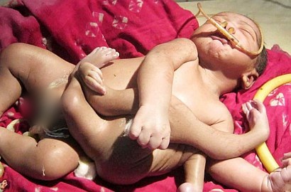 Bayi Terlahir Miliki 4 Kaki dan 4 Tangan Bikin Heboh India