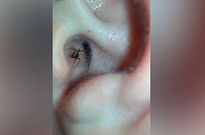 Menakutkan, Pria Ini Rekam Laba-laba Mematikan Keluar dari Telinganya