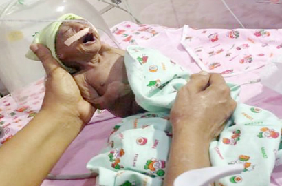 Terlahir dengan Kulit Keriput, Bayi di India Tak Diakui Ortunya