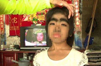 Kasihan, Gadis Tiongkok Terkena Sindrom Manusia Serigala