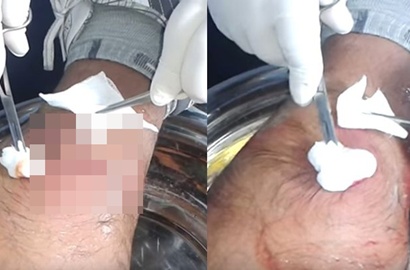 Menjijikkan, dari Kaki Orang Ini Nanah Menyembur Setelah Mengendap 3 Bulan