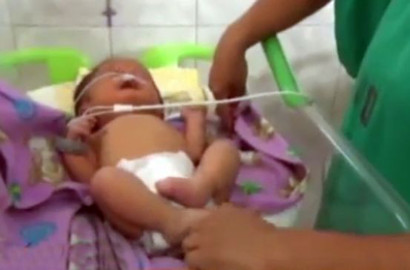 Alami Kelainan Genetik Langka, Bayi Ini Lahir dengan 'Dua Hidung'