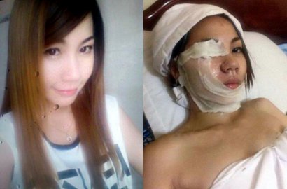 Astaga, Gadis Ini Siram Pacarnya dengan Cairan Kimia Gara-Gara Ogah Diputus