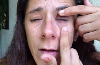 Wanita Ini Sempat Buta Gara-Gara Teman Salah Kira Lem Jadi Obat Tetes Mata