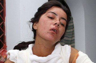 Tolak Lamaran, Wanita Pakistan Ini Justru Dibakar Sang Kekasih