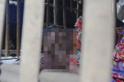 Alami Kelainan Genetik, Gadis Muda Ini Tak Miliki 'Wajah'